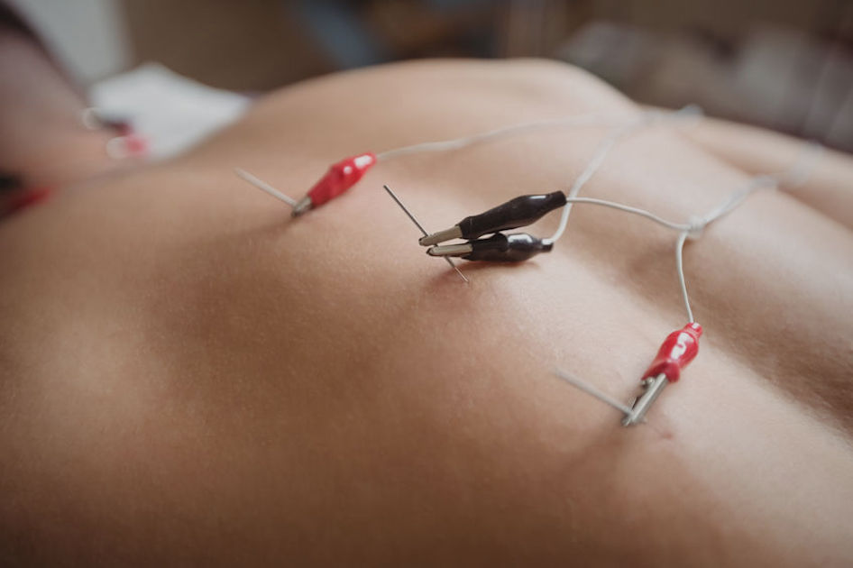 memphis electroacupuncture