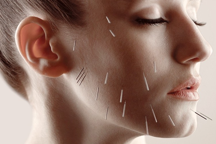 memphis facial acupuncture