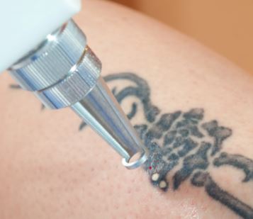 #1 Tattoo Removal Corpus Christi | Tattoo Removal Services