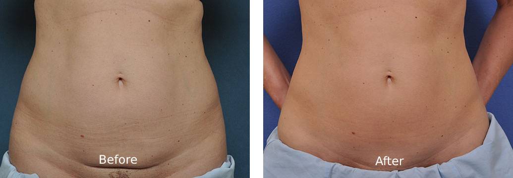 Mini Tummy Tuck Utah l Fairbanks Art of Plastic Surgery | Salt Lake City, UT