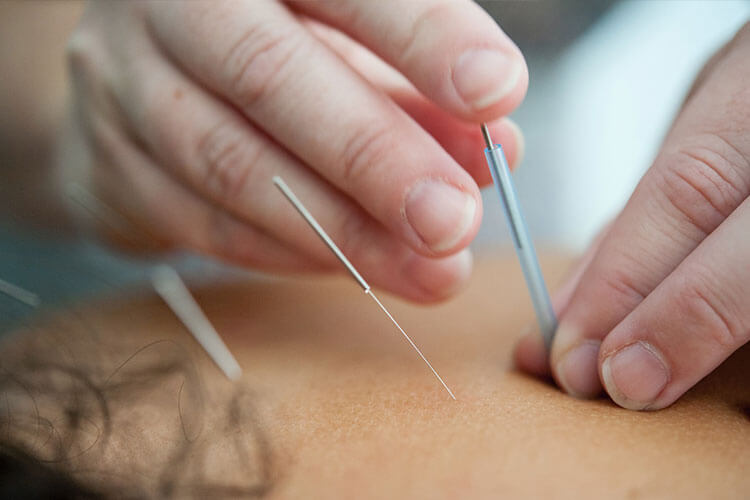 acupuncture