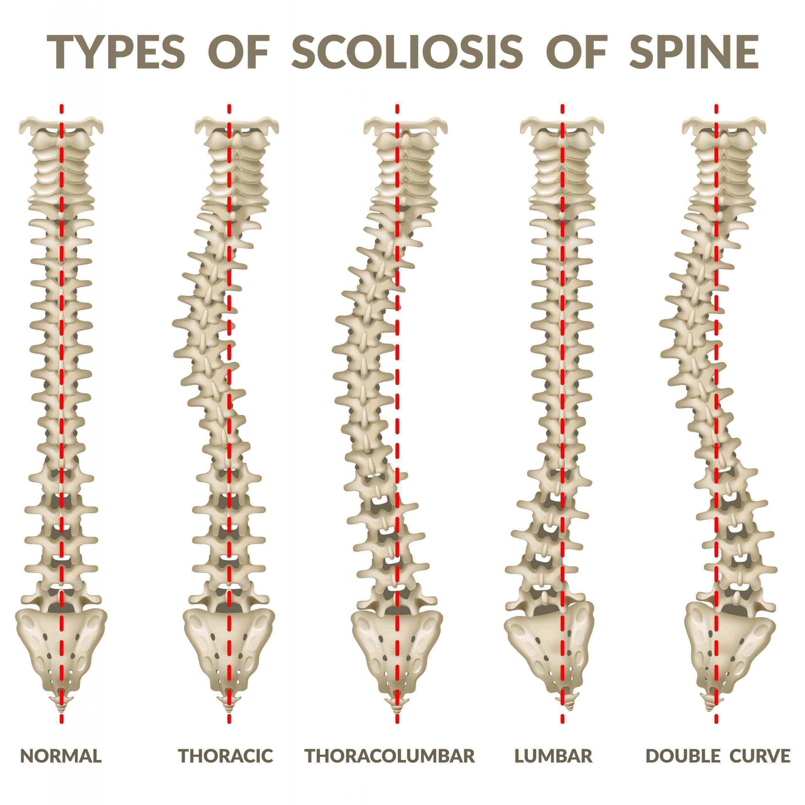 scoliosis-chiropractor-golden-co-scoliosis-treatment-center-colorado