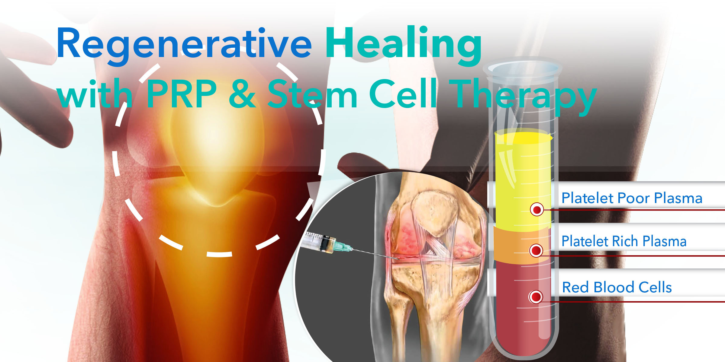 Regenerative Medicine Stem Cell Therapy Platelet Rich Plasma Prp